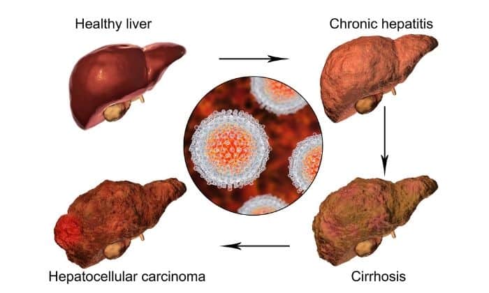 Diagram of livers at various stages of alcohol induced liver disease and liver cancer