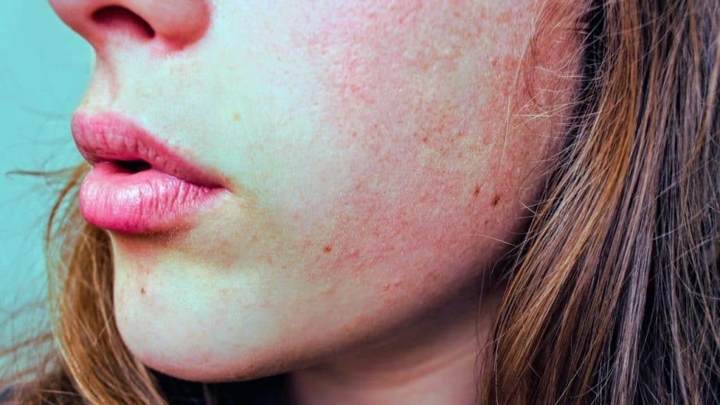 Red, dry skin on a woman's cheek from alcohol